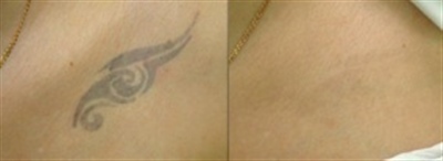 Лазерное удаление татуировок (фото: до и после)