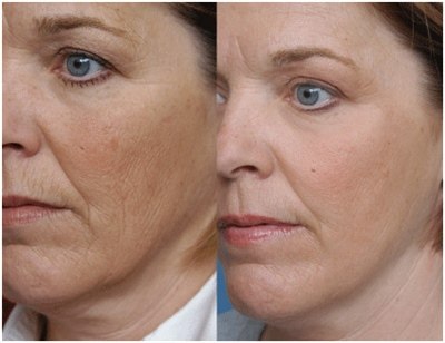 Плазмолифтинг лица (фото: до и после)