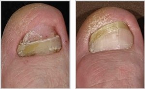 Лечение грибка ногтей на ногах (фото: до и после)
