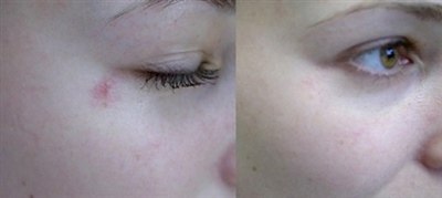Лазерное удаление сосудов на лице (фото: до и после)